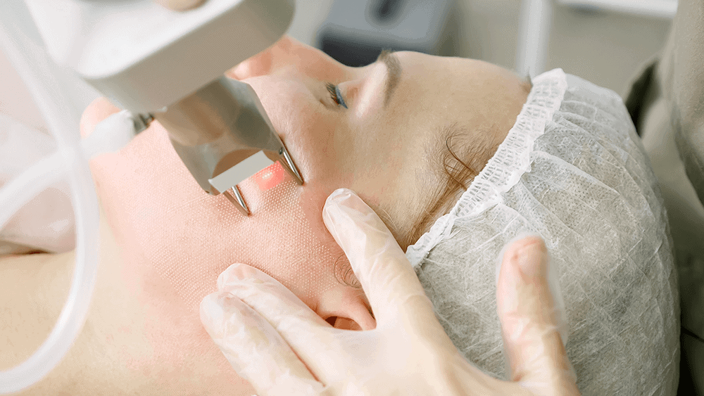 Laserowe leczenie trądziku różowatego