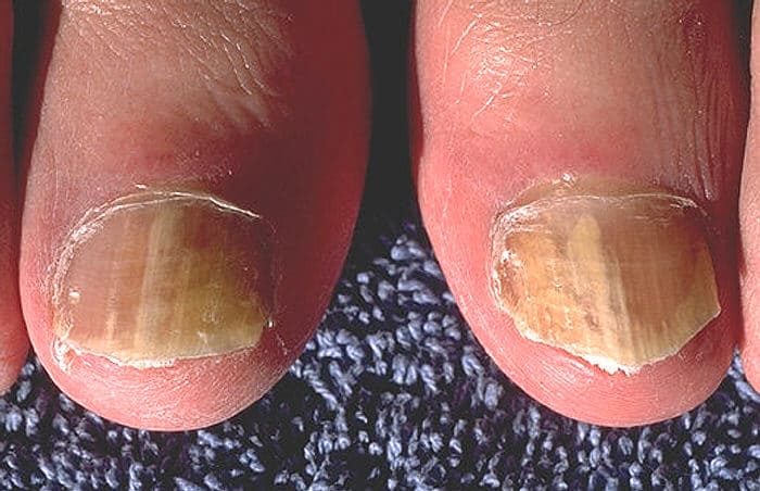 Jak leczyć grzybicę paznokci