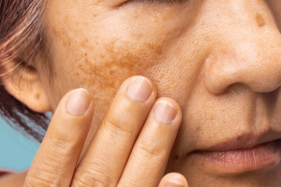 Melasma – jak usunąć przebarwienia skórne