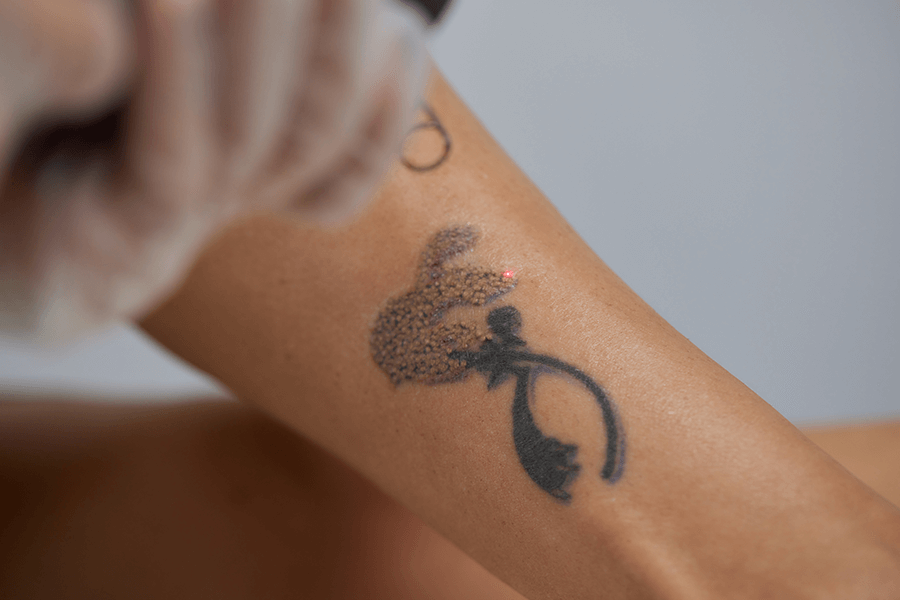 Co warto wiedzieć o usuwaniu tatuażu